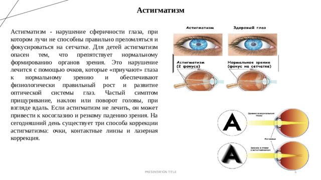 Астигматизм Астигматизм - нарушение сферичности глаза, при котором лучи не способны правильно преломляться и фокусироваться на сетчатке. Для детей астигматизм опасен тем, что препятствует нормальному формированию органов зрения. Это нарушение лечится с помощью очков, которые «приучают» глаза к нормальному зрению и обеспечивают физиологически правильный рост и развитие оптической системы глаз. Частый симптом прищуривание, наклон или поворот головы, при взгляде вдаль. Если астигматизм не лечить, он может привести к косоглазию и резкому падению зрения. На сегодняшний день существует три способа коррекции астигматизма: очки, контактные линзы и лазерная коррекция. PRESENTATION TITLE