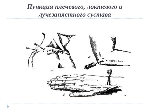 Пункция плечевого, локтевого и лучезапястного сустава