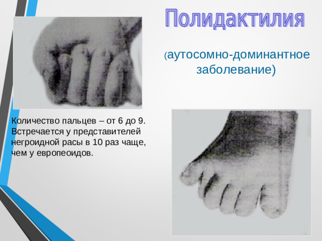 ( аутосомно-доминантное заболевание) Количество пальцев – от 6 до 9. Встречается у представителей негроидной расы в 10 раз чаще, чем у европеоидов.
