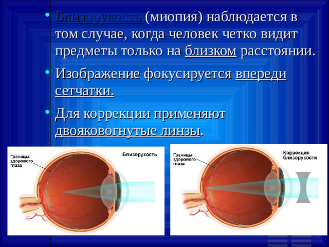 Близорукость (миопия) наблюдается в том случае, когда человек четко видит предметы только на близком расстоянии. Изображение фокусируется впереди сетчатки. Для коррекции применяют двояковогнутые линзы