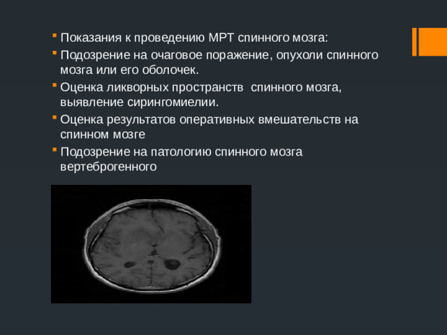 Показания к проведению МРТ спинного мозга: Подозрение на очаговое поражение, опухоли спинного мозга или его оболочек. Оценка ликворных пространств  спинного мозга, выявление сирингомиелии. Оценка результатов оперативных вмешательств на спинном мозге Подозрение на патологию спинного мозга вертеброгенного