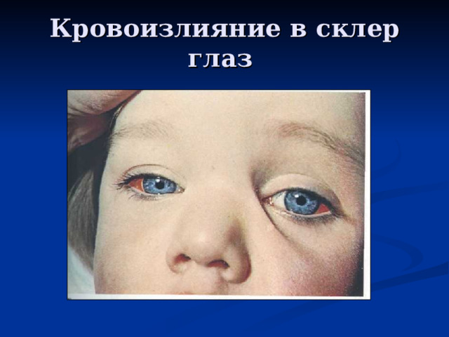 Кровоизлияние в склер глаз
