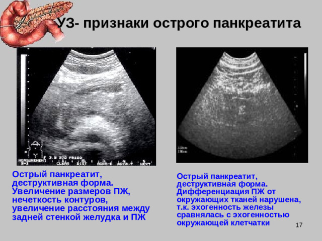 УЗ- признаки острого панкреатита Острый панкреатит, деструктивная форма. Увеличение размеров ПЖ, нечеткость контуров, увеличение расстояния между задней стенкой желудка и ПЖ Острый панкреатит, деструктивная форма. Дифференциация ПЖ от окружающих тканей нарушена, т.к. эхогенность железы сравнялась с эхогенностью окружающей клетчатки