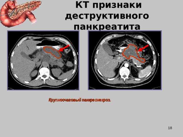 КТ признаки деструктивного  панкреатита  Крупноочаговый панкреонекроз.