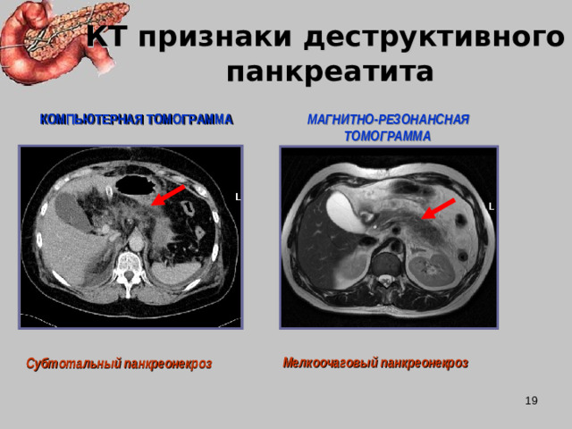 КТ признаки деструктивного  панкреатита  КОМПЬЮТЕРНАЯ ТОМОГРАММА  МАГНИТНО-РЕЗОНАНСНАЯ ТОМОГРАММА Мелкоочаговый панкреонекроз Субтотальный панкреонекроз