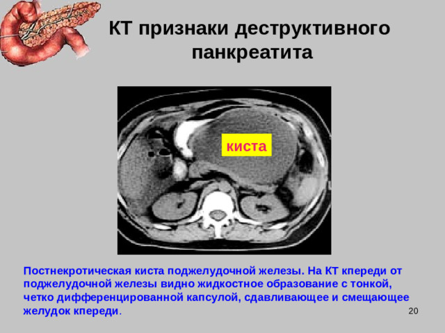 КТ признаки деструктивного  панкреатита киста Постнекротическая киста поджелудочной железы. На КТ кпереди от поджелудочной железы видно жидкостное образование с тонкой, четко дифференцированной капсулой, сдавливающее и смещающее желудок кпереди .