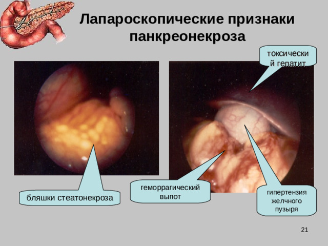 Лапароскопические признаки панкреонекроза токсический гепатит геморрагический выпот гипертензия желчного пузыря бляшки стеатонекроза