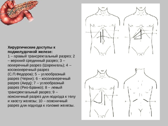 Хирургические доступы к поджелудочной железе:  1 – правый трансректальный разрез; 2 – верхний срединный разрез; 3 – поперечный разрез (Шпренгель); 4 – косопоперечный разрез (С.П.Федоров); 5 – углообразный разрез (Черни); 6 – косопоперечный разрез (Аирд); 7 – углообразный разрез (Рио-Бранко); 8 – левый трансректальный разрез; 9 – поясничный разрез для подхода к телу и хвосту железы; 10 – поясничный разрез для подхода к головке железы.