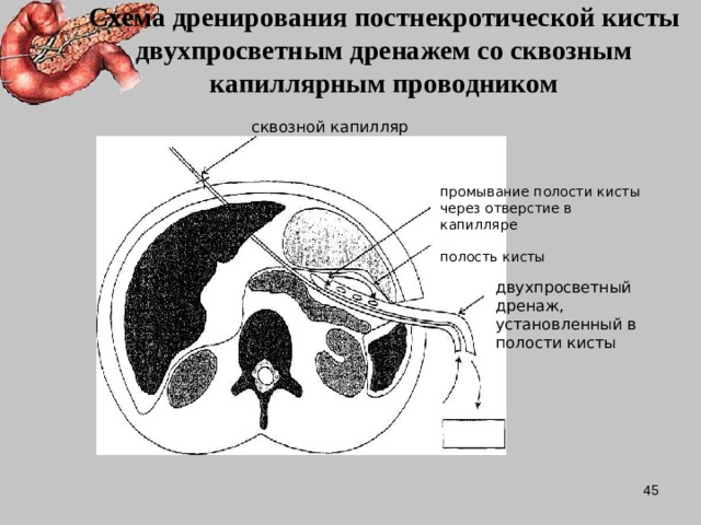 Схема дренирования постнекротической кисты двухпросветным дренажем со сквозным капиллярным проводником сквозной капилляр промывание полости кисты через отверстие в капилляре полость кисты двухпросветный дренаж, установленный в полости кисты