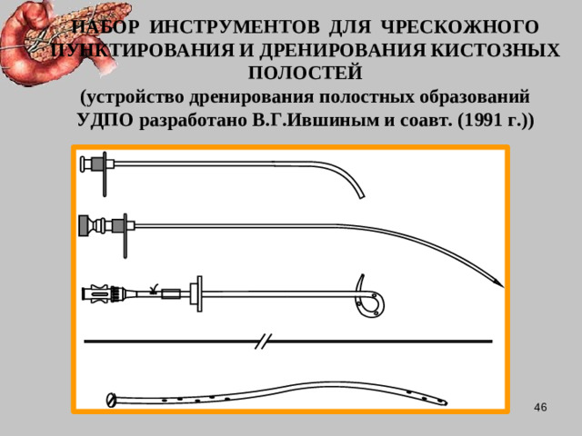 НАБОР ИНСТРУМЕНТОВ ДЛЯ ЧРЕСКОЖНОГО ПУНКТИРОВАНИЯ И ДРЕНИРОВАНИЯ КИСТОЗНЫХ ПОЛОСТЕЙ  (устройство дренирования полостных образований УДПО разработано В.Г.Ившиным и соавт. (1991 г.))