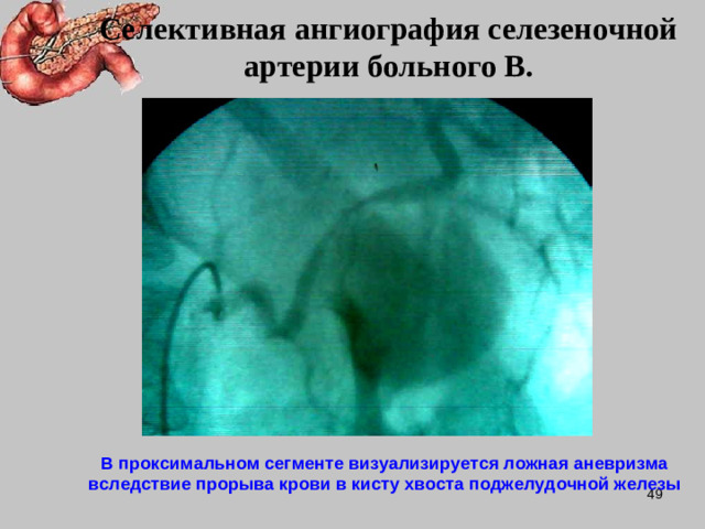Селективная ангиография селезеночной артерии больного В. В проксимальном сегменте визуализируется ложная аневризма вследствие прорыва крови в кисту хвоста поджелудочной железы