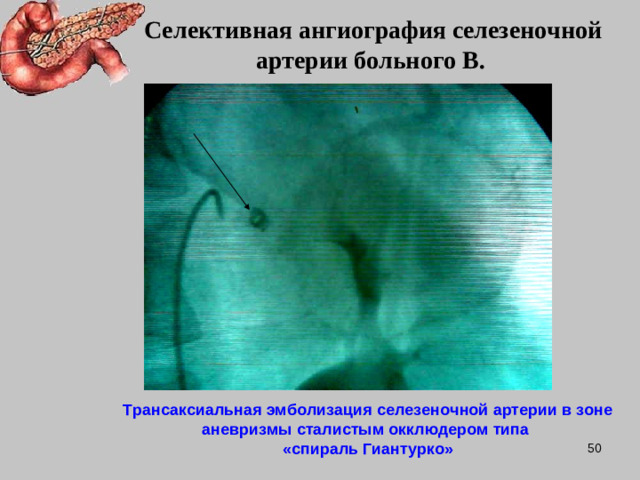 Селективная ангиография селезеночной артерии больного В. Трансаксиальная эмболизация селезеночной артерии в зоне аневризмы сталистым окклюдером типа  «спираль Гиантурко»