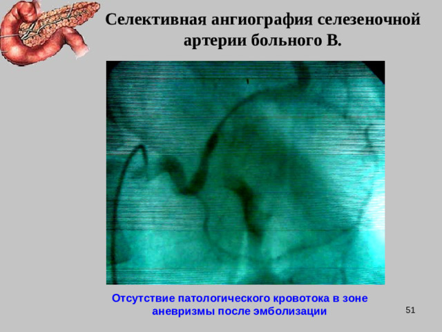 Селективная ангиография селезеночной артерии больного В. Отсутствие патологического кровотока в зоне аневризмы после эмболизации