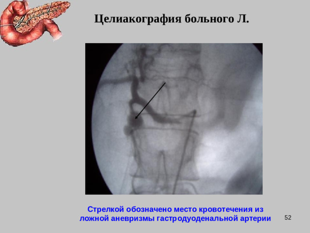 Целиакография больного Л. Стрелкой обозначено место кровотечения из ложной аневризмы гастродуоденальной артерии