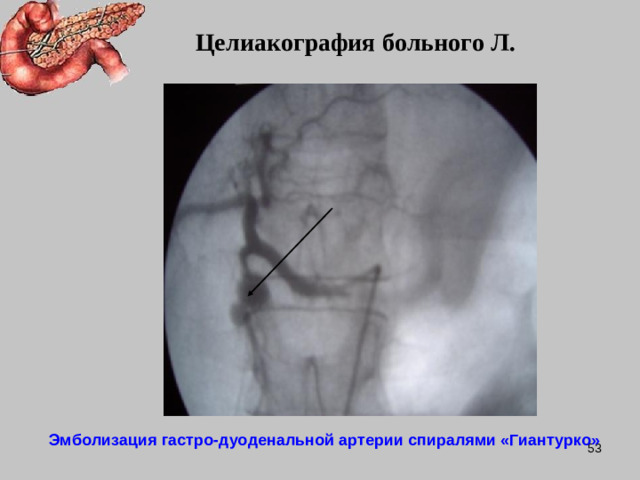 Целиакография больного Л. Эмболизация гастро-дуоденальной артерии спиралями «Гиантурко»