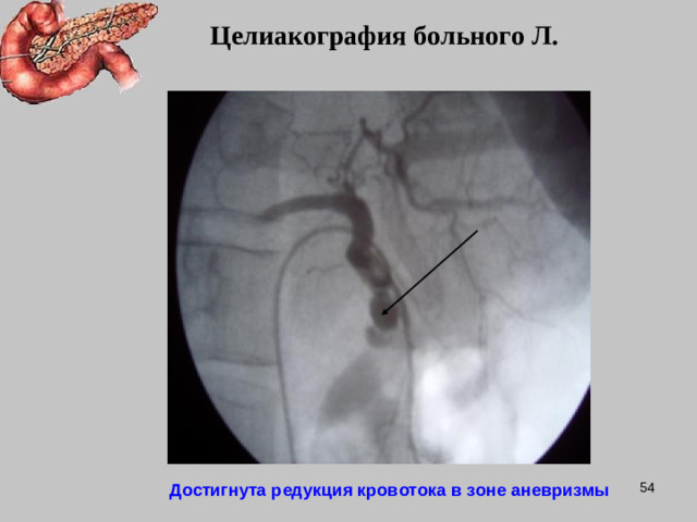 Целиакография больного Л.  Достигнута редукция кровотока в зоне аневризмы