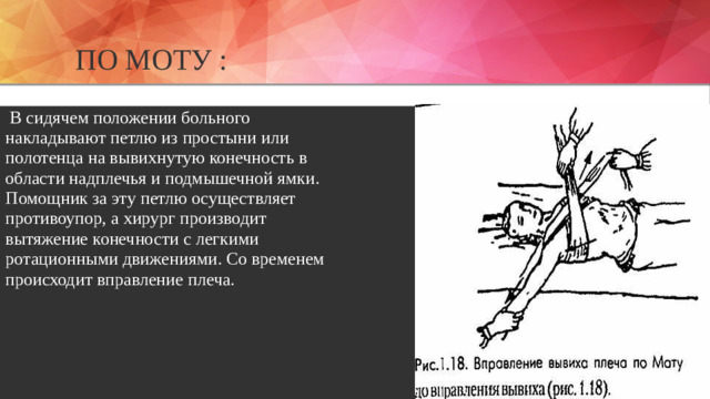 По МОТУ :   В сидячем положении больного накладывают петлю из простыни или полотенца на вывихнутую конечность в области надплечья и подмышечной ямки. Помощник за эту петлю осуществляет противоупор, а хирург производит вытяжение конечности с легкими ротационными движениями. Со временем происходит вправление плеча.
