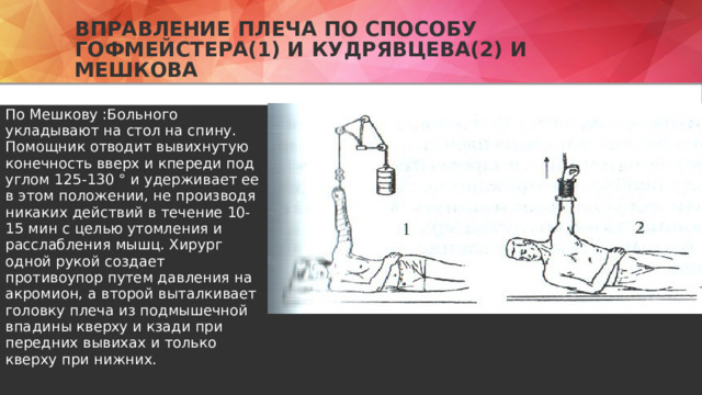 Вправление плеча по способу Гофмейстера(1) и Кудрявцева(2) и мешкова По Мешкову :Больного укладывают на стол на спину. Помощник отводит вывихнутую конечность вверх и кпереди под углом 125-130 ° и удерживает ее в этом положении, не производя никаких действий в течение 10-15 мин с целью утомления и расслабления мышц. Хирург одной рукой создает противоупор путем давления на акромион, а второй выталкивает головку плеча из подмышечной впадины кверху и кзади при передних вывихах и только кверху при нижних.