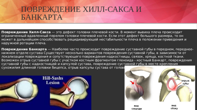 Повреждение Хилл-Сакса и Банкарта Повреждение Хилл-Сакса  — это дефект головки плечевой кости. В момент вывиха плеча происходит ограниченный вдавленный перелом головки плечевой кости. Если этот дефект большого размера, то он может в дальнейшем способствовать рецидивирующей нестабильности плеча в положении приведения и наружной ротации плеча. Повреждение Банкарта  — Наиболее часто происходит повреждение суставной губы в переднем, переднее-нижнем отделе сустава Существует несколько вариантов повреждения суставной губы, в зависимости от локализации повреждения и сопутствующего повреждения надкостницы, связок, хряща, костной ткани. Возможен отрыв суставной губы с участком костным фрагментом гленоида - костный Банкарт, повреждения суставной губы с надкостницей и капсулой сустава, повреждение суставной губы в месте крепления сухожилия длинной головки бицепса, отрыв капсулы сустава от головки плеча.