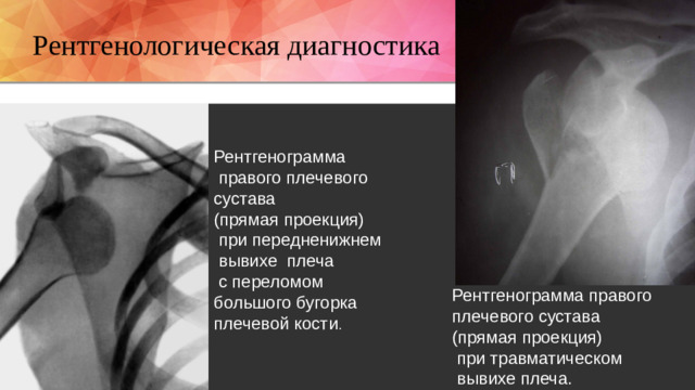 Рентгенологическая диагностика Рентгенограмма  правого плечевого сустава (прямая проекция)  при передненижнем  вывихе плеча  с переломом большого бугорка плечевой кости . Рентгенограмма правого  плечевого сустава  (прямая проекция)  при травматическом  вывихе плеча.