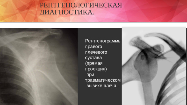 Рентгенологическая диагностика. Рентгенограммы правого плечевого сустава  (прямая проекция)  при травматическом  вывихе плеча.