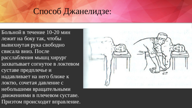 Способ Джанелидзе : Больной в течение 10-20 мин лежит на боку так, чтобы вывихнутая рука свободно свисала вниз. После расслабления мышц хирург захватывает согнутое в локтевом суставе предплечье и надавливает на него ближе к локтю, сочетая давление с небольшими вращательными движениями в плечевом суставе. Приэтом происходит вправление.