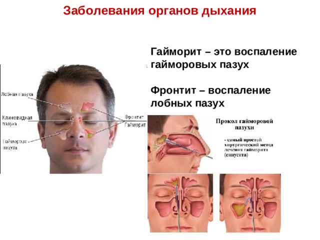 Заболевания органов дыхания Гайморит – это воспаление гайморовых пазух Фронтит – воспаление лобных пазух