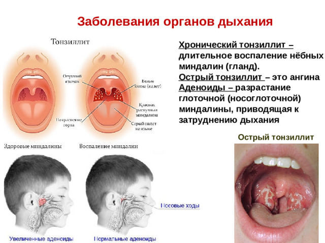 Заболевания органов дыхания Хронический тонзиллит – длительное воспаление нёбных миндалин (гланд). Острый тонзиллит – это ангина Аденоиды – разрастание глоточной (носоглоточной) миндалины, приводящая к затруднению дыхания Острый тонзиллит