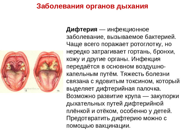 Заболевания органов дыхания Дифтерия — инфекционное заболевание, вызываемое бактерией. Чаще всего поражает ротоглотку, но нередко затрагивает гортань, бронхи, кожу и другие органы. Инфекция передаётся в основном воздушно-капельным путём. Тяжесть болезни связана с ядовитым токсином, который выделяет дифтерийная палочка. Возможно развитие крупа — закупорки дыхательных путей дифтерийной плёнкой и отёком, особенно у детей. Предотвратить дифтерию можно с помощью вакцинации.