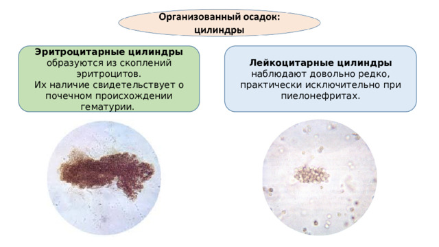 Эритроцитарные цилиндры образуются из скоплений эритроцитов. Лейкоцитарные цилиндры наблюдают довольно редко, практически исключительно при пиелонефритах. Их наличие свидетельствует о почечном происхождении гематурии.