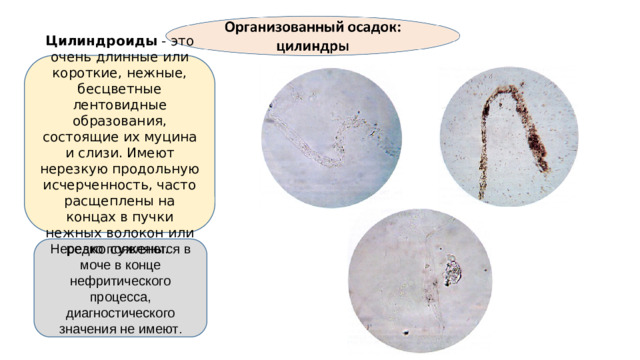 Цилиндроиды - это очень длинные или короткие, нежные, бесцветные лентовидные образования, состоящие их муцина и слизи. Имеют нерезкую продольную исчерченность, часто расщеплены на концах в пучки нежных волокон или резко сужены. Нередко появляются в моче в конце нефритического процесса, диагностического значения не имеют .