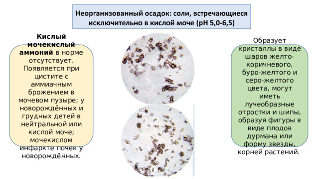 Образует кристаллы в виде шаров желто-коричневого, буро-желтого и серо-желтого цвета, могут иметь лучеобразные отростки и шипы, образуя фигуры в виде плодов дурмана или форму звезды, корней растений. Кислый мочекислый аммоний в норме отсутствует. Появляется при цистите с аммиачным брожением в мочевом пузыре; у новорождённых и грудных детей в нейтральной или кислой моче; мочекислом инфаркте почек у новорождённых.