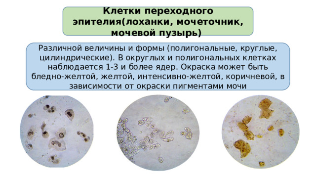 Клетки переходного эпителия(лоханки, мочеточник, мочевой пузырь) Различной величины и формы (полигональные, круглые, цилиндрические). В округлых и полигональных клетках наблюдается 1-3 и более ядер. Окраска может быть бледно-желтой, желтой, интенсивно-желтой, коричневой, в зависимости от окраски пигментами мочи