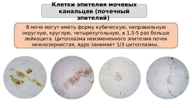 Клетки эпителия мочевых канальцев (почечный эпителий) В моче могут иметь форму кубическую, неправильную округлую, круглую, четырехугольную, в 1,5-5 раз больше лейкоцита. Цитоплазма неизмененного эпителия почек нежнозернистая, ядро занимает 1/3 цитоплазмы.