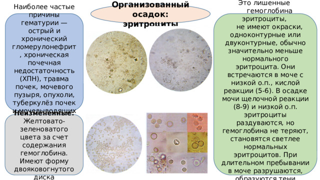 Организованный осадок: эритроциты Наиболее частые причины гематурии — острый и хронический гломерулонефрит, хроническая почечная недостаточность (ХПН), травма почек, мочевого пузыря, опухоли, туберкулёз почек и мочевыводящих путей. Измененные: Это лишенные  гемоглобина эритроциты,  не имеют окраски, одноконтурные или двуконтурные, обычно значительно меньше нормального эритроцита. Они встречаются в моче с низкой о.п., кислой реакции (5-6). В осадке мочи щелочной реакции (8-9) и низкой о.п. эритроциты раздуваются, но гемоглобина не теряют, становятся светлее нормальных эритроцитов. При длительном пребывании в моче разрушаются, образуются тени эритроцитов, стоматоциты, шизоциты Неизмененные: Желтовато-зеленоватого цвета за счет содержания гемоглобина. Имеют форму двояковогнутого диска