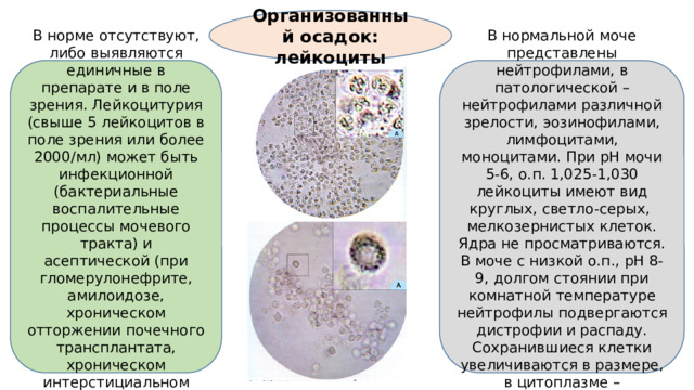 Организованный осадок: лейкоциты В норме отсутствуют, либо выявляются единичные в препарате и в поле зрения. Лейкоцитурия (свыше 5 лейкоцитов в поле зрения или более 2000/мл) может быть инфекционной (бактериальные воспалительные процессы мочевого тракта) и асептической (при гломерулонефрите, амилоидозе, хроническом отторжении почечного трансплантата, хроническом интерстициальном нефрите). В нормальной моче представлены нейтрофилами, в патологической – нейтрофилами различной зрелости, эозинофилами, лимфоцитами, моноцитами. При рН мочи 5-6, о.п. 1,025-1,030 лейкоциты имеют вид круглых, светло-серых, мелкозернистых клеток. Ядра не просматриваются. В моче с низкой о.п., рН 8-9, долгом стоянии при комнатной температуре нейтрофилы подвергаются дистрофии и распаду. Сохранившиеся клетки увеличиваются в размере, в цитоплазме – броуновское движение.