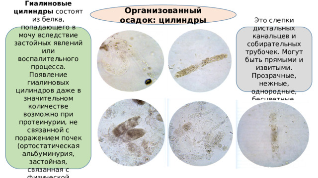 Организованный осадок: цилиндры Гиалиновые цилиндры состоят из белка, попадающего в мочу вследствие застойных явлений или воспалительного процесса. Появление гиалиновых цилиндров даже в значительном количестве возможно при протеинурии, не связанной с поражением почек (ортостатическая альбуминурия, застойная, связанная с физической нагрузкой, охлаждением). Это слепки дистальных канальцев и собирательных трубочек. Могут быть прямыми и извитыми. Прозрачные, нежные, однородные, бесцветные.