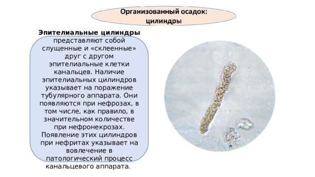Эпителиальные цилиндры представляют собой слущенные и «склеенные» друг с другом эпителиальные клетки канальцев. Наличие эпителиальных цилиндров указывает на поражение тубулярного аппарата. Они появляются при нефрозах, в том числе, как правило, в значительном количестве при нефронекрозах. Появление этих цилиндров при нефритах указывает на вовлечение в патологический процесс канальцевого аппарата.