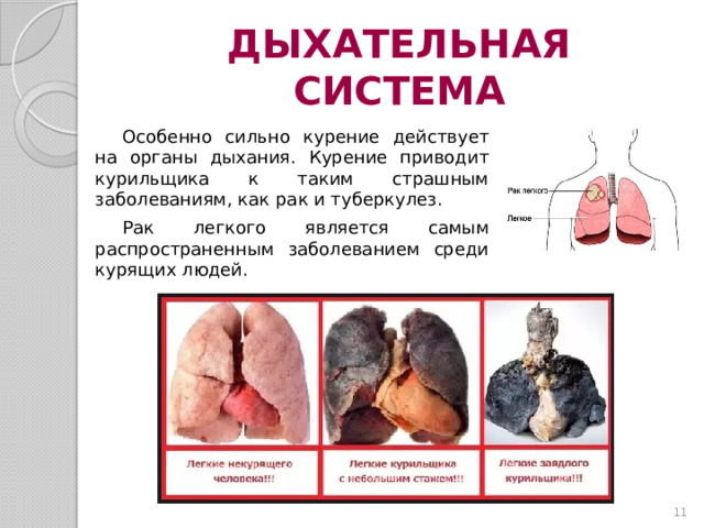 ДЫХАТЕЛЬНАЯ СИСТЕМА Особенно сильно курение действует на органы дыхания. Курение приводит курильщика к таким страшным заболеваниям, как рак и туберкулез. Рак легкого является самым распространенным заболеванием среди курящих людей.