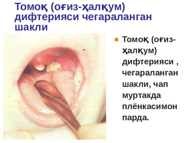 Томоқ (оғиз-ҳалқум) дифтерияси чегараланган шакли