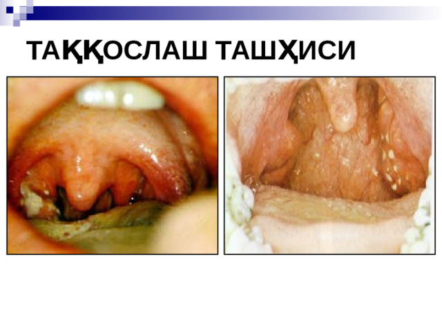 ТАҚҚОСЛАШ ТАШҲИСИ  Инфекцион мононуклеоз Фолликуляр ангина