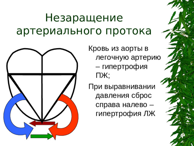 Незаращение артериального протока Кровь из аорты в легочную артерию – гипертрофия ПЖ; При выравнивании давления сброс справа налево – гипертрофия ЛЖ