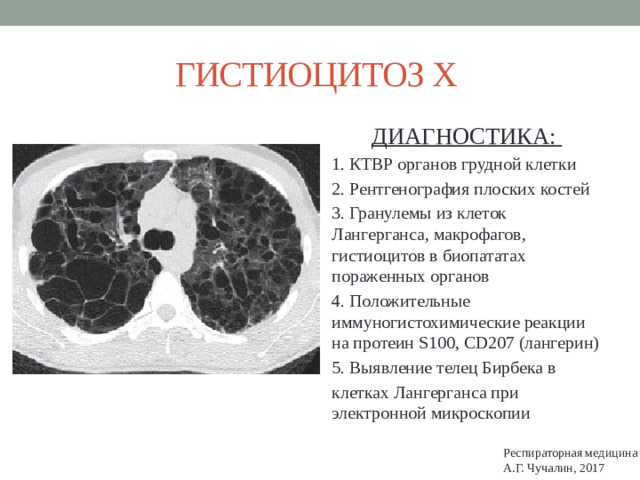 ГИСТИОЦИТОЗ Х ДИАГНОСТИКА: 1. КТВР органов грудной клетки 2. Рентгенография плоских костей 3. Гранулемы из клеток Лангерганса, макрофагов, гистиоцитов в биопататах пораженных органов 4. Положительные иммуногистохимические реакции на протеин S100, CD207 (лангерин) 5. Выявление телец Бирбека в клетках Лангерганса при электронной микроскопии Респираторная медицина А.Г. Чучалин, 2017