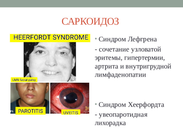 САРКОИДОЗ Синдром Лефгрена - сочетание узловатой эритемы, гипертермии, артрита и внутригрудной лимфаденопатии Синдром Хеерфордта - увеопаротидная лихорадка