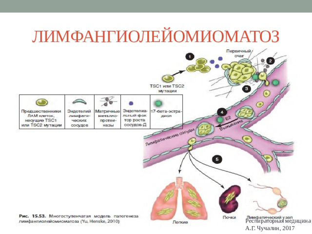 ЛИМФАНГИОЛЕЙОМИОМАТОЗ Респираторная медицина А.Г. Чучалин, 2017