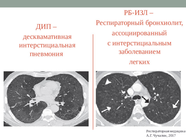 РБ-ИЗЛ – Респираторный бронхиолит, ассоциированный с интерстициальным заболеванием легких ДИП – десквамативная интерстициальная пневмония Респираторная медицина А.Г. Чучалин, 2017