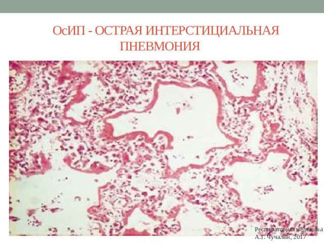 ОсИП - ОСТРАЯ ИНТЕРСТИЦИАЛЬНАЯ ПНЕВМОНИЯ Респираторная медицина А.Г. Чучалин, 2017