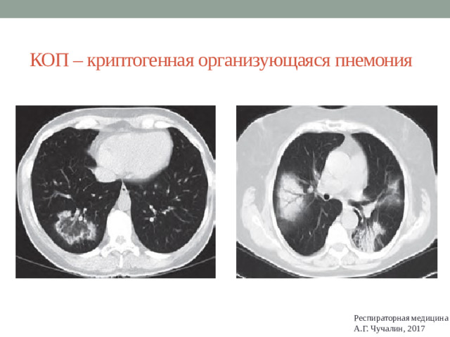 КОП – криптогенная организующаяся пнемония Респираторная медицина А.Г. Чучалин, 2017