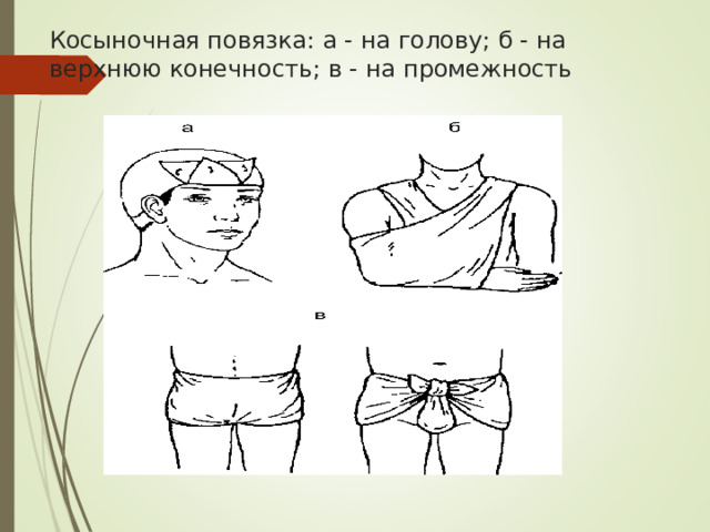 Косыночная повязка: а - на голову; б - на верхнюю конечность; в - на промежность