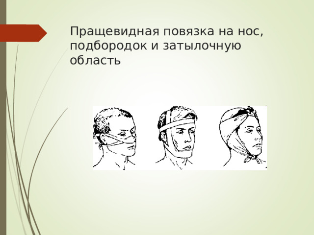 Пращевидная повязка на нос, подбородок и затылочную область
